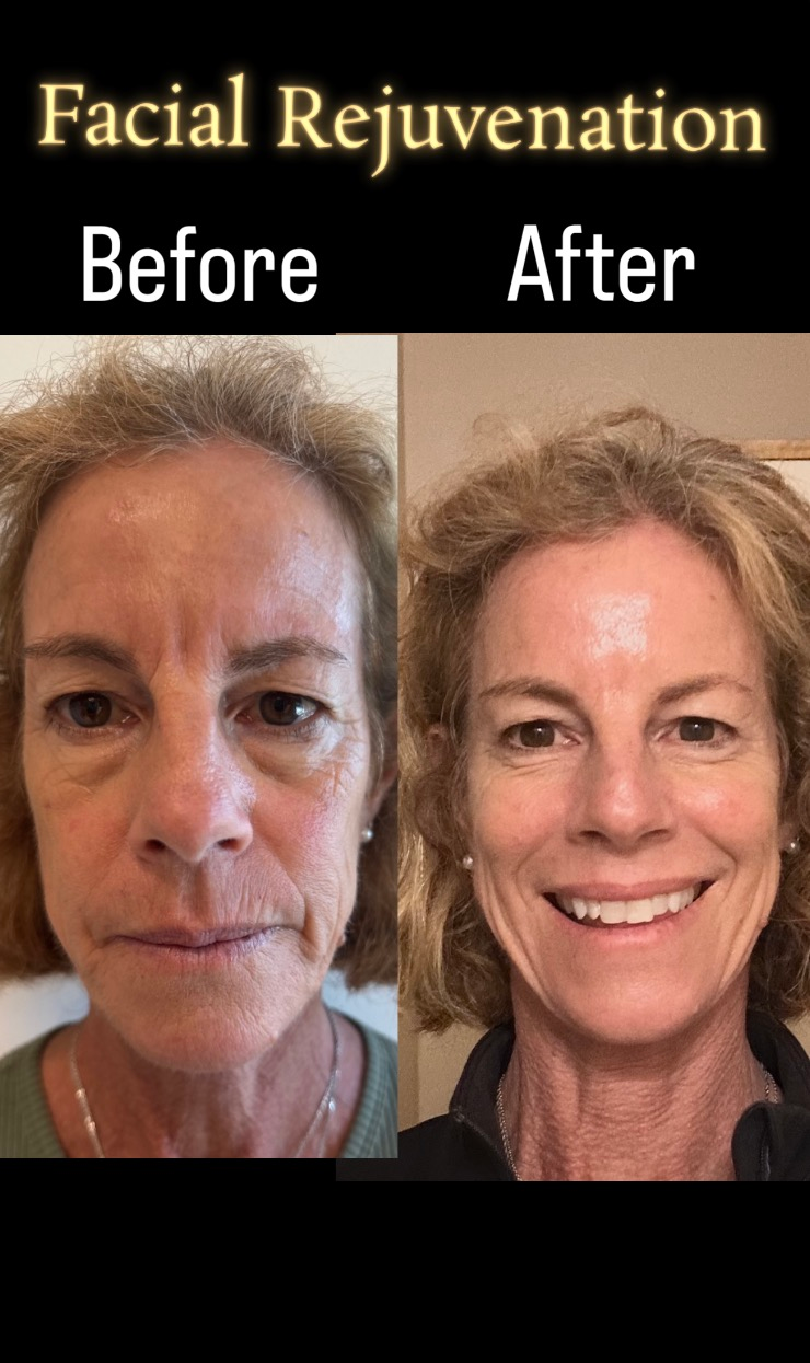 Before and after facial rejuvenation