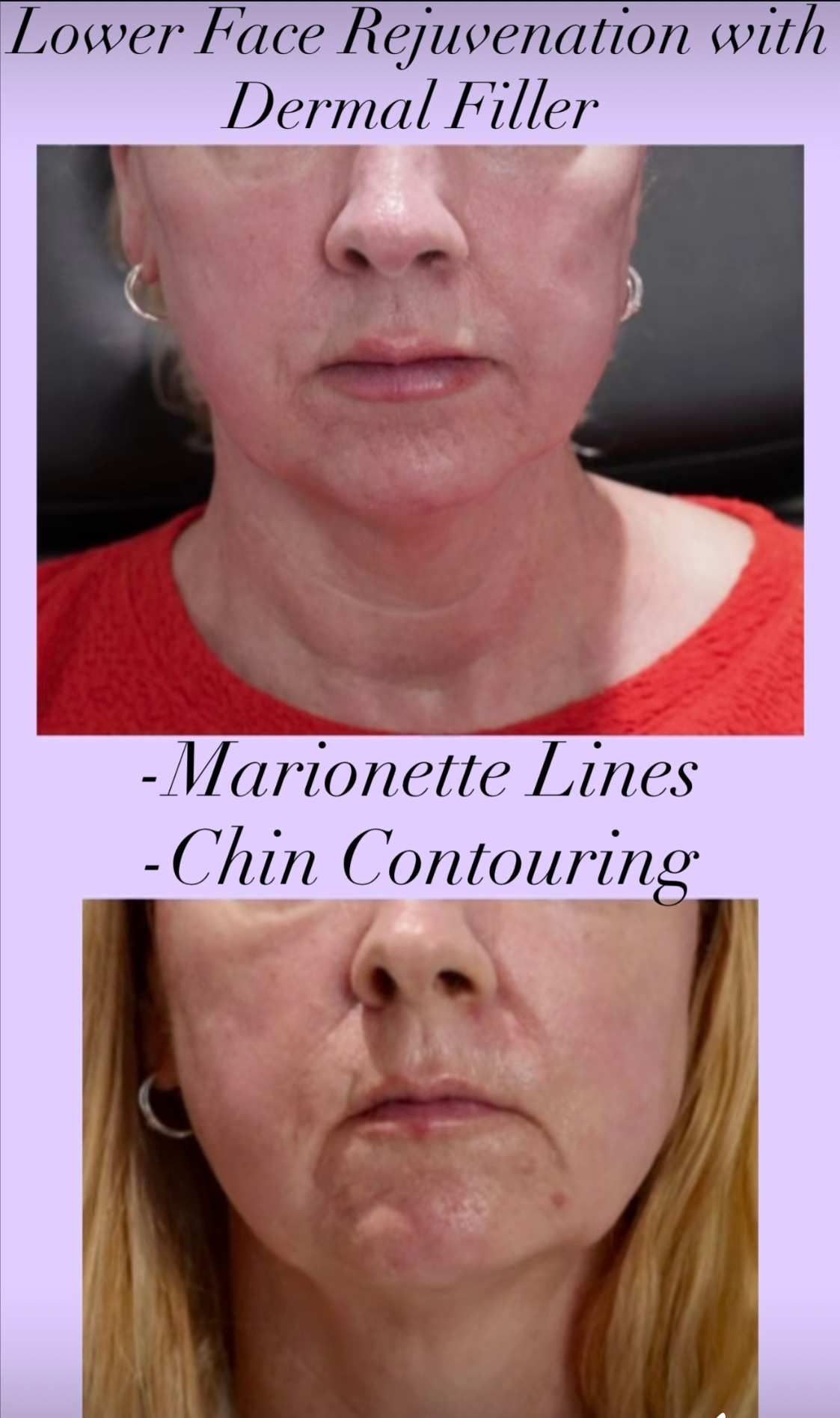 Before and after lower face rejuvenation with dermal filler for marionette lines and chin contouring