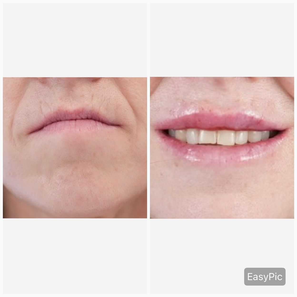 Before and after lip filler