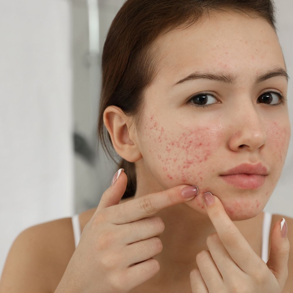 Acne Treatment at Superior Health