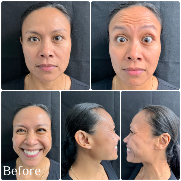 Emface Before 