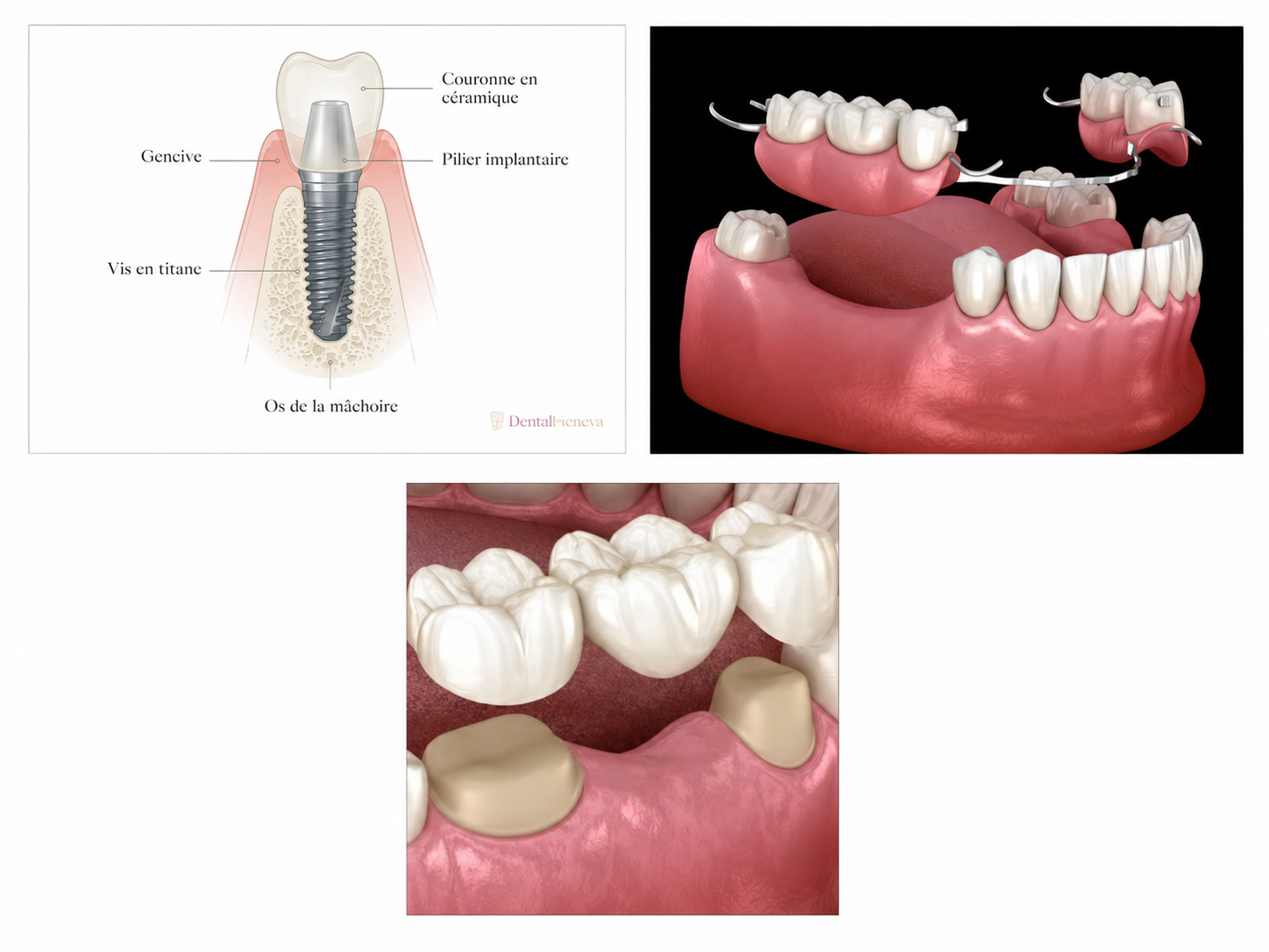 Illustration d'implants dentaires montrant des piliers et des couronnes en titane dans la gencive, avec des vues rapprochées et en coupe.
