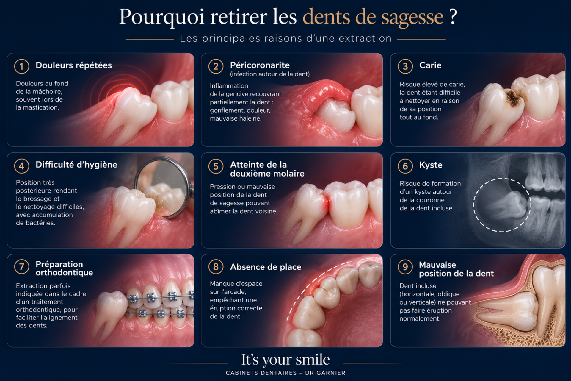 Infographie française expliquant les raisons de l'extraction des dents de sagesse, avec radiographies dentaires et illustrations buccales