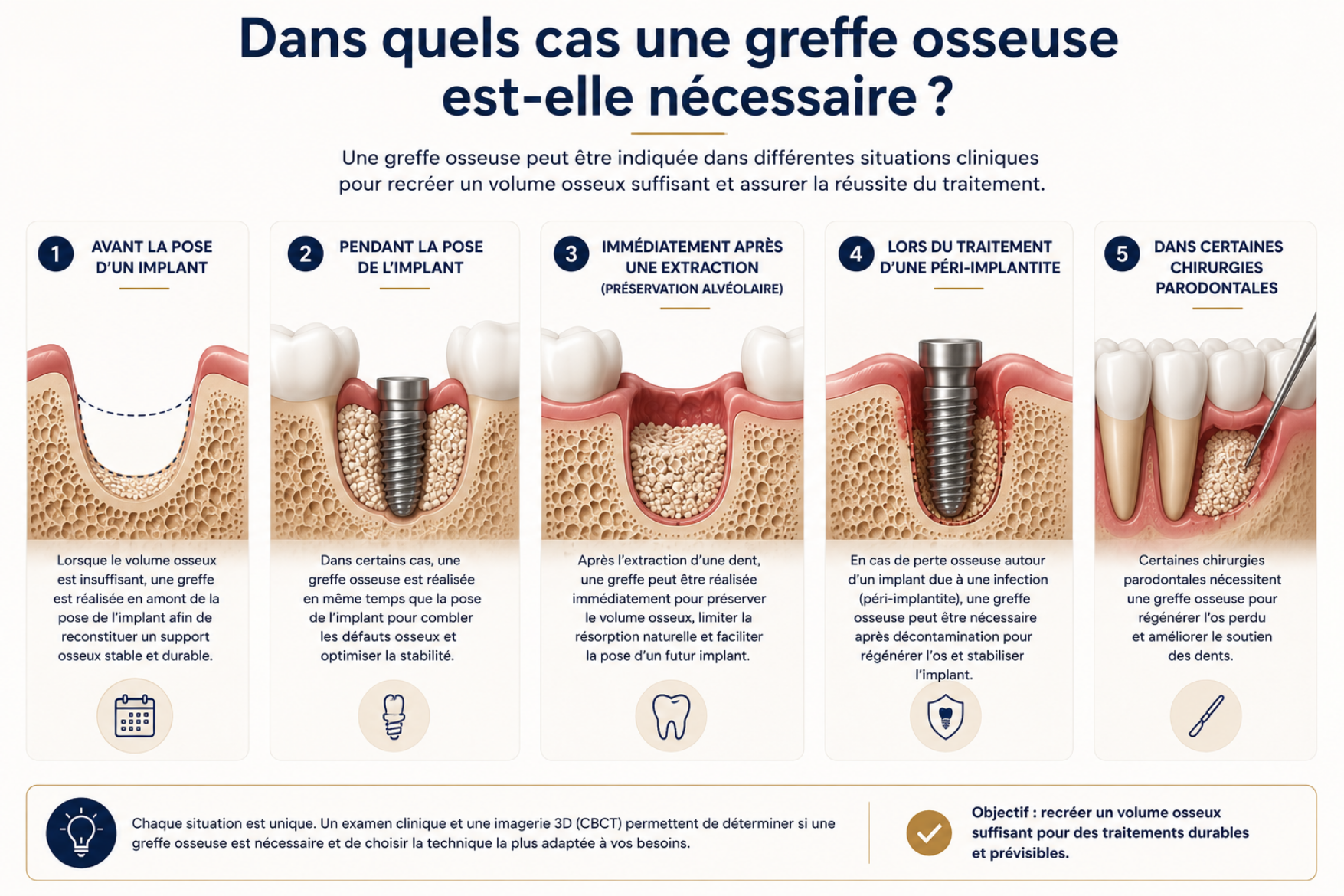 Infographie en français sur la greffe osseuse dentaire, avec étapes illustrées et schémas de mâchoire.