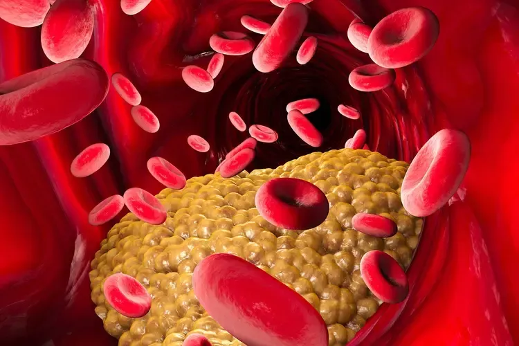Hyperlipidemia Graphic Illustration