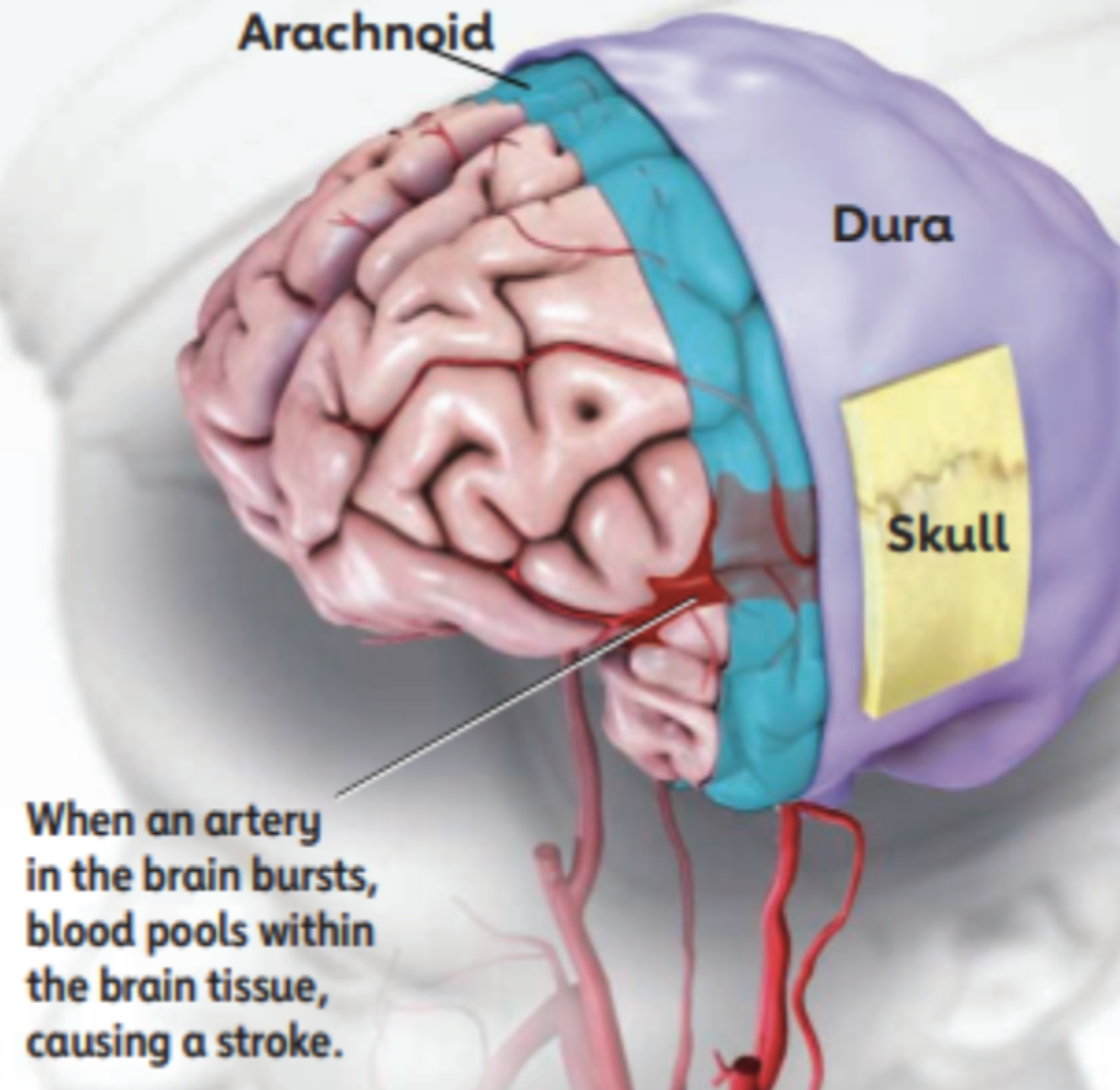 Hemorrhagic stroke illustration showing a ruptured cerebral artery with blood pooling in brain tissue.