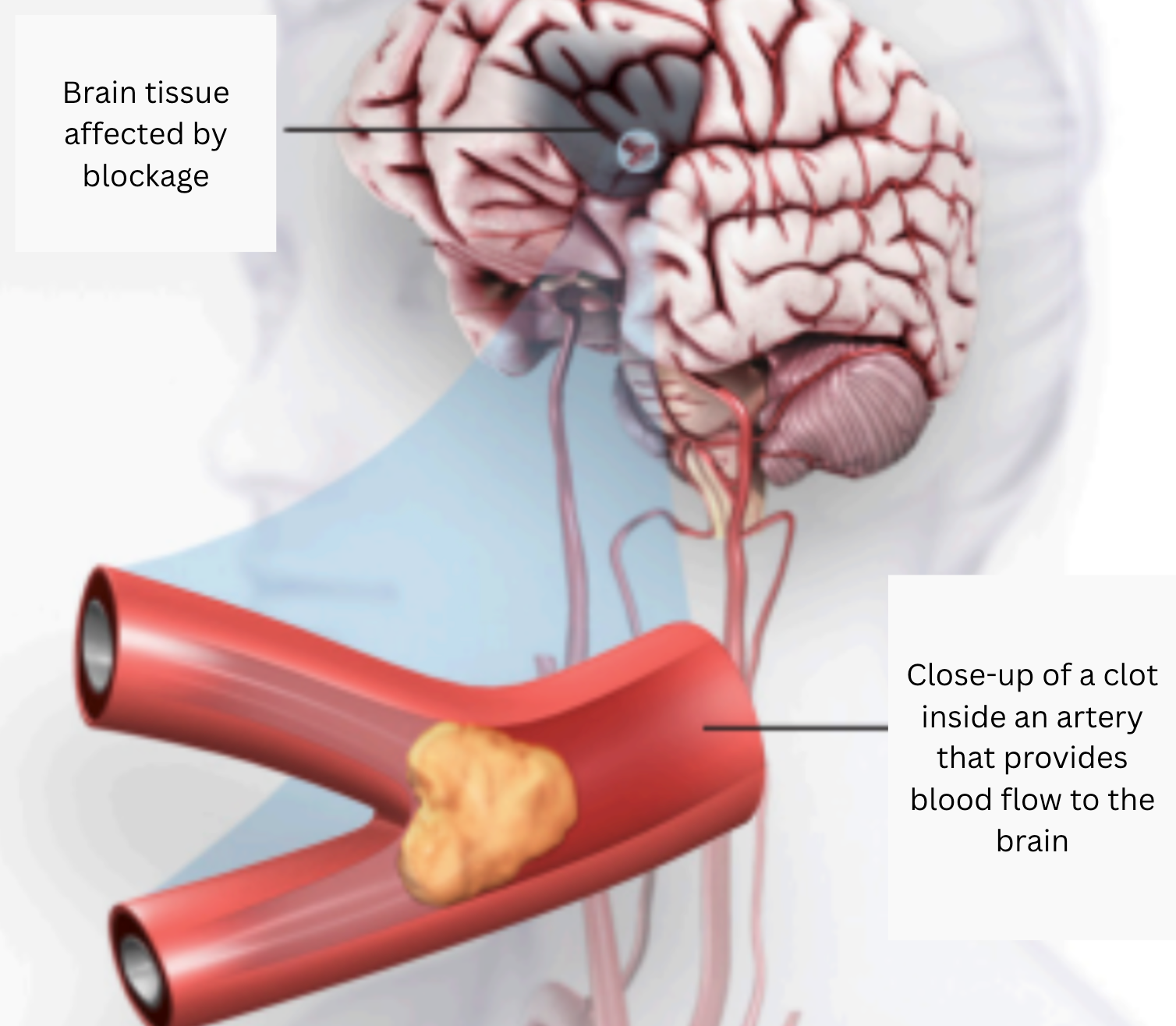 Illustration of an ischemic stroke caused by a blood clot blocking an artery supplying blood to the brain