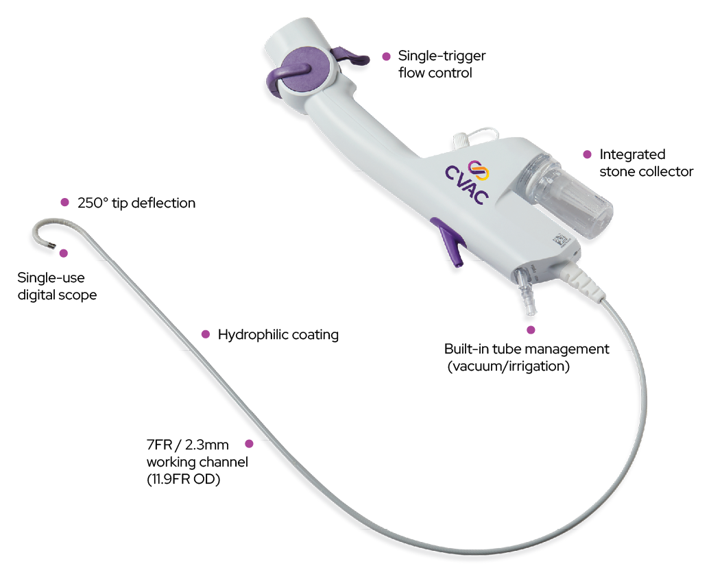 Illustration of the Calyxo Sure procedure using the CVac system for kidney stone treatment