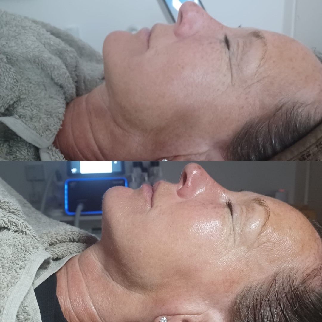 A before and after picture of a woman 's face at Results Skincare Studio in Fort Myers