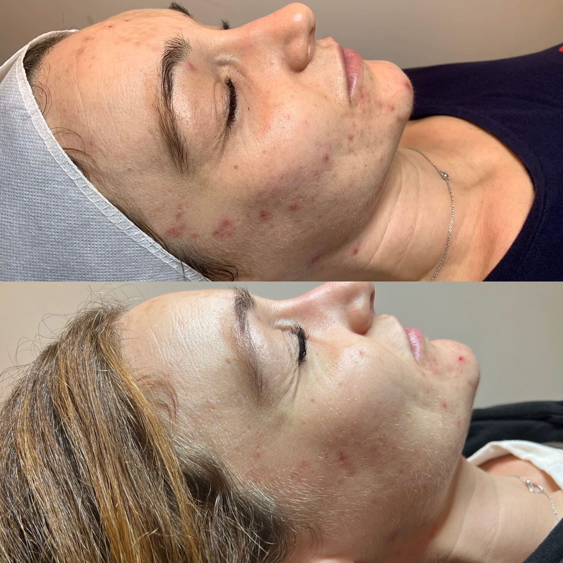 A before and after photo of a woman 's face with acne at Results Skincare Studio in Fort Myers