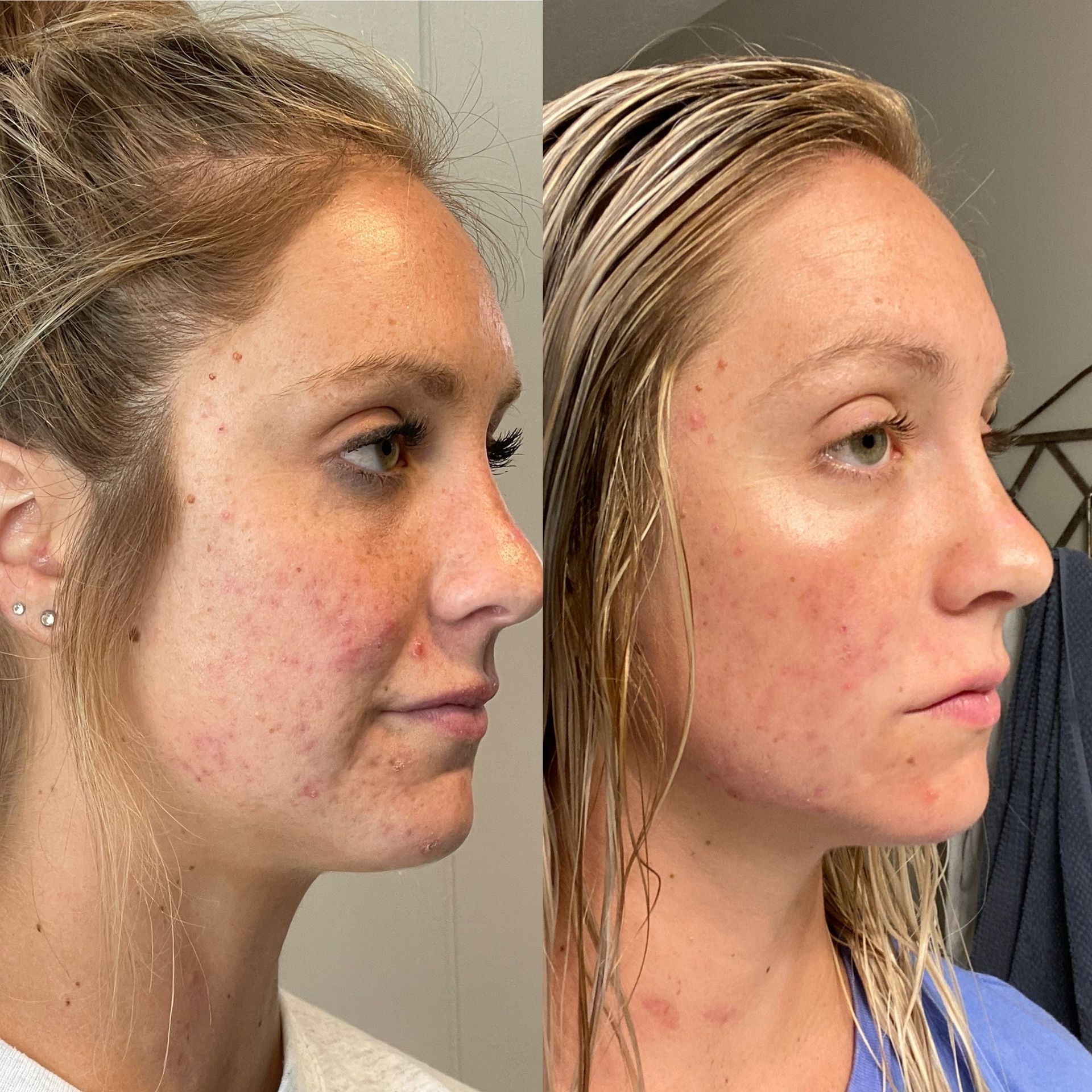 A before and after photo of a woman 's face at Results Skincare Studio in Fort Myers