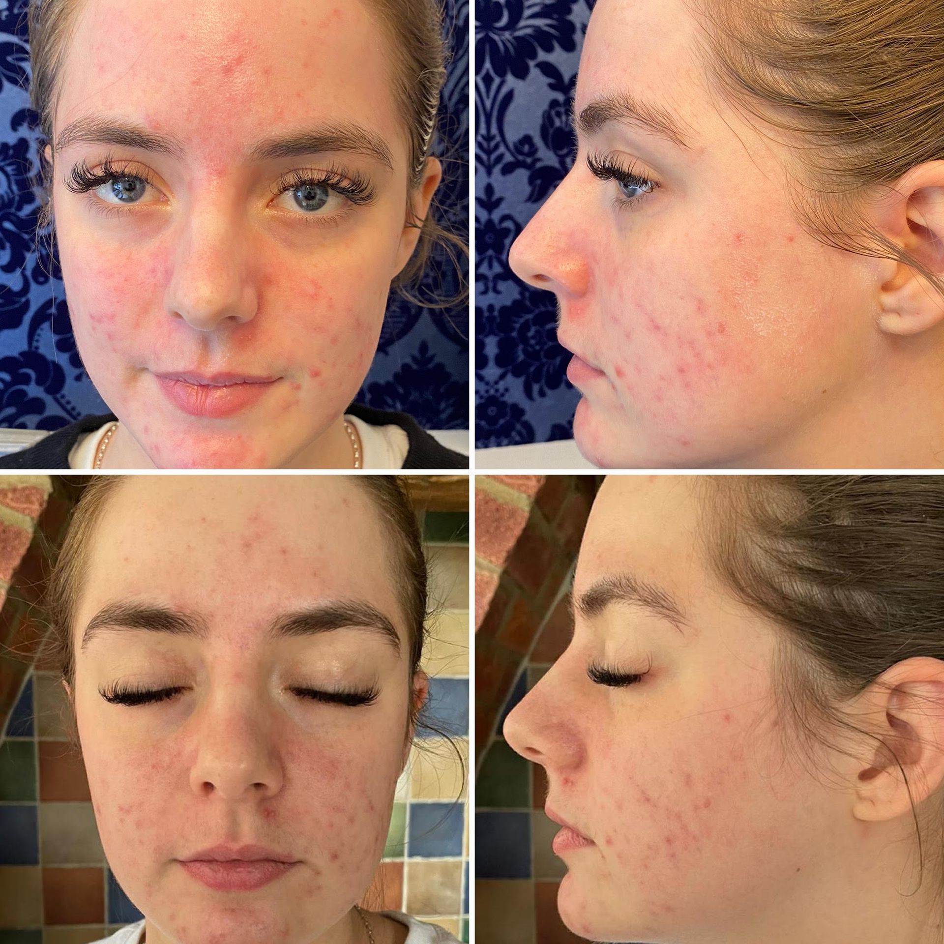 A woman with acne on her face is shown from different angles at Results Skincare Studio in Fort Myers