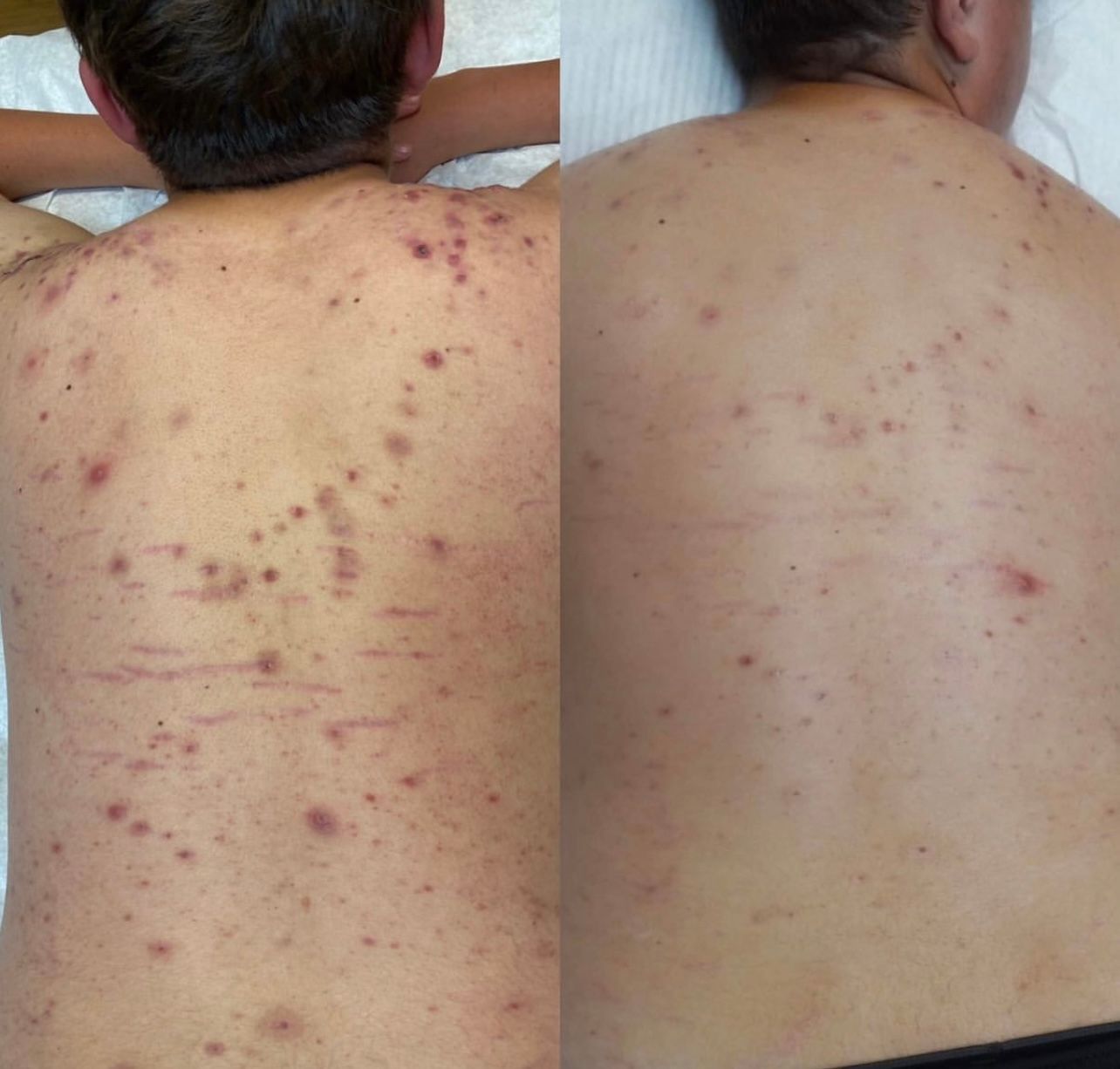 A before and after picture of a person 's back with acne at Results Skincare Studio in Fort Myers