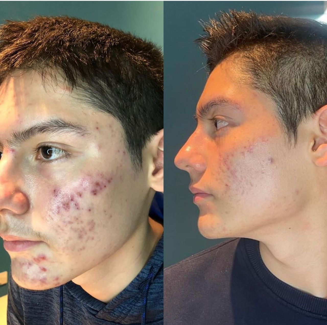 A before and after photo of a man with acne on his face at Results Skincare Studio in Fort Myers