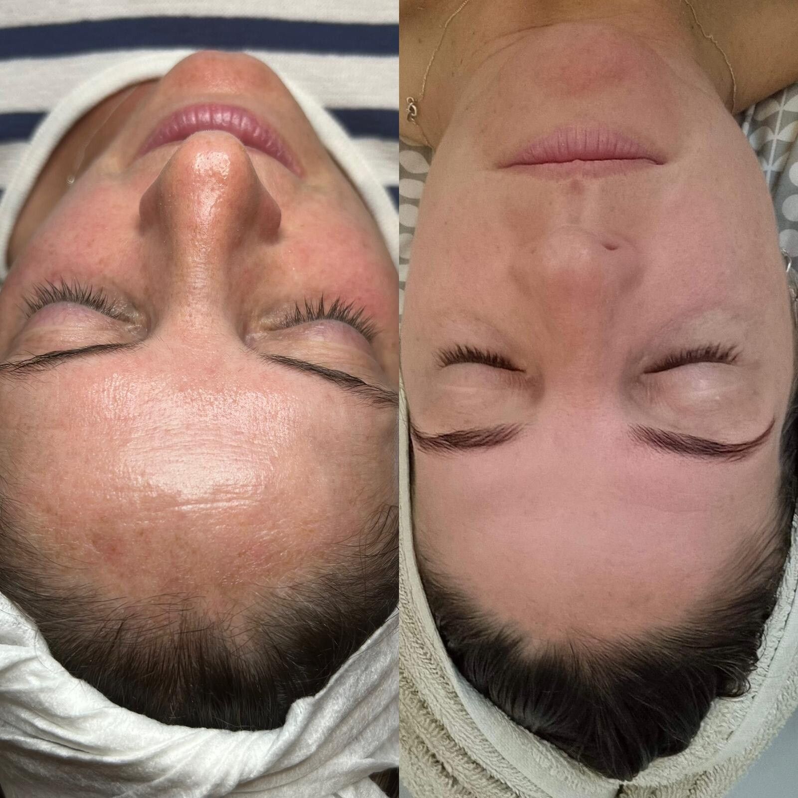 A before and after photo of a woman 's face with her eyes closed at Results Skincare Studio in Fort Myers