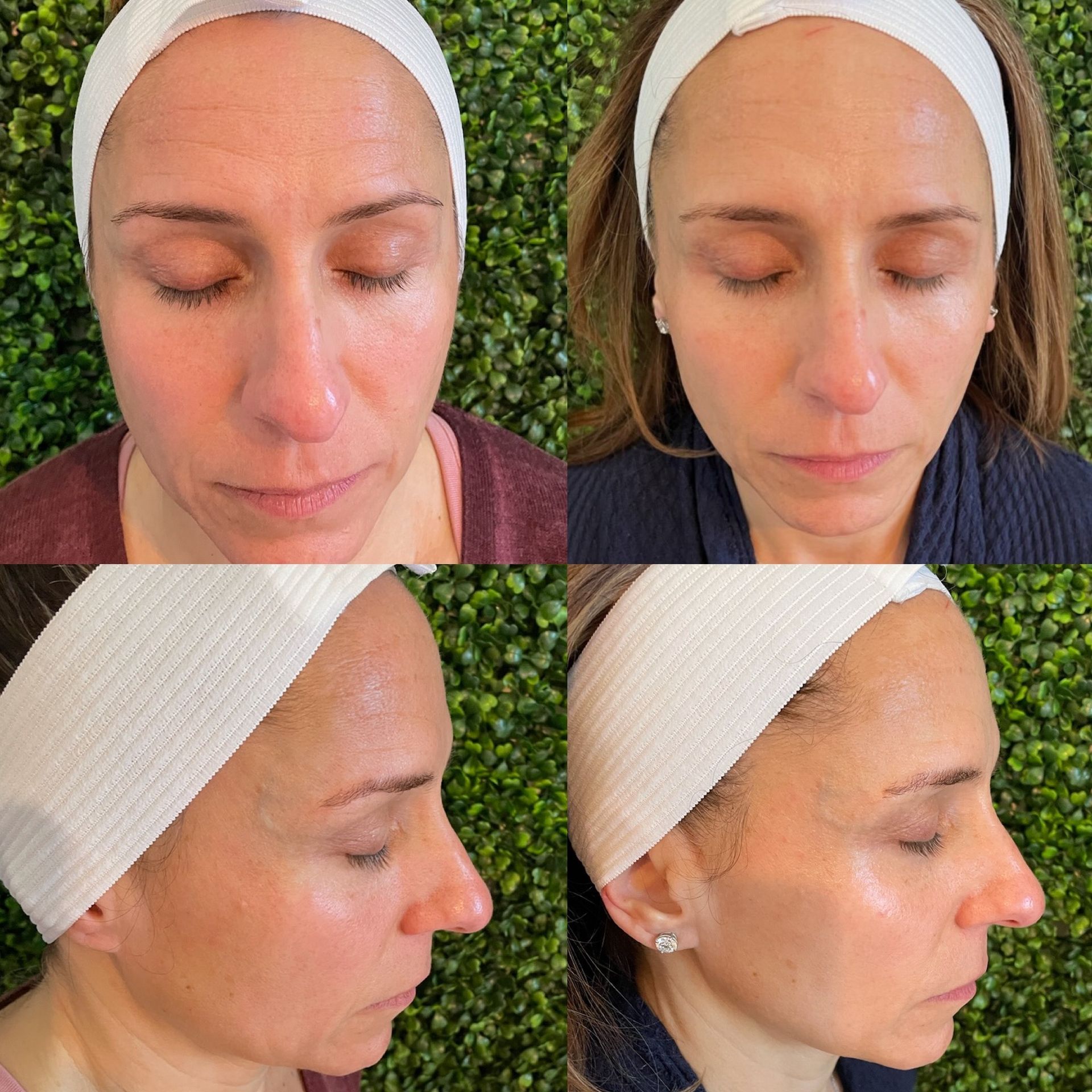 A woman wearing a headband is shown from different angles at Results Skincare Studio in Fort Myers