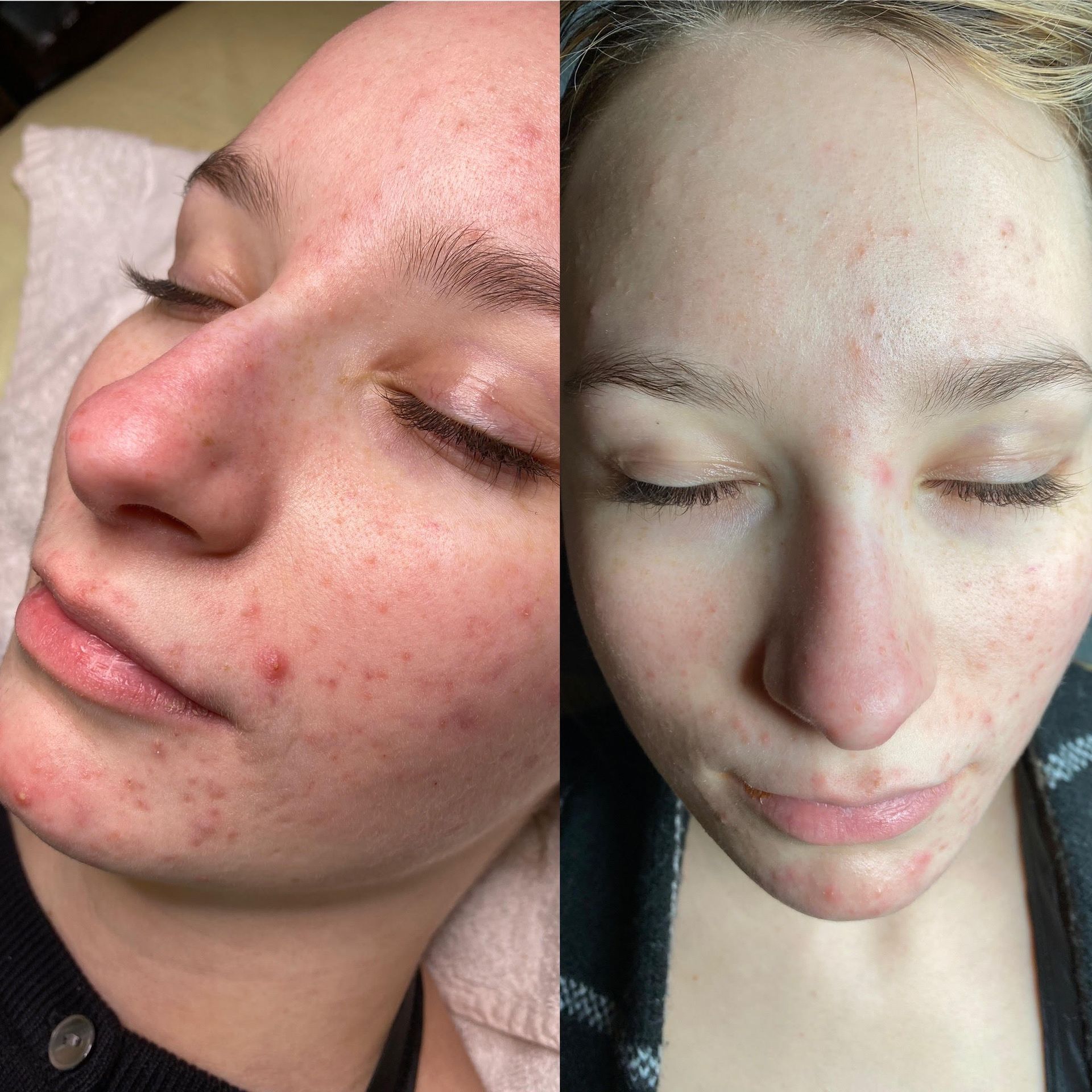 A before and after photo of a woman 's face at Results Skincare Studio in Fort Myers