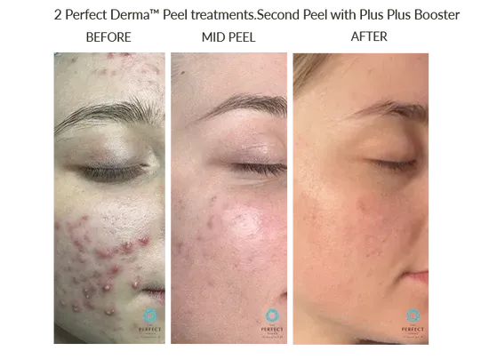 Before, mid, and after photos showing acne and skin improvement after a peel treatment