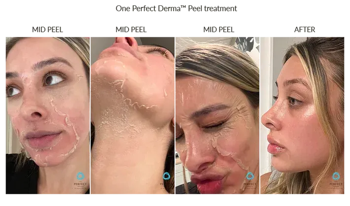 Before-and-after peel treatment collage showing skin peeling on a face and neck, ending with a clear profile portrait