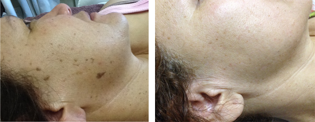 A before and after picture of a woman 's face at Results Skincare Studio in Fort