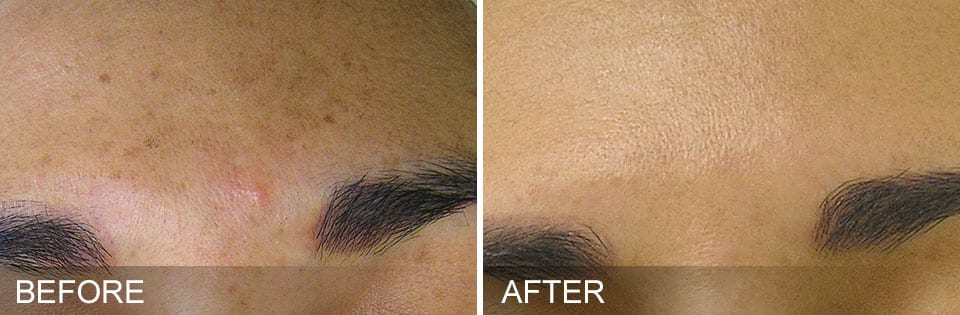 A before and after photo of a woman 's forehead at Results Skincare Studio in Fort Myers