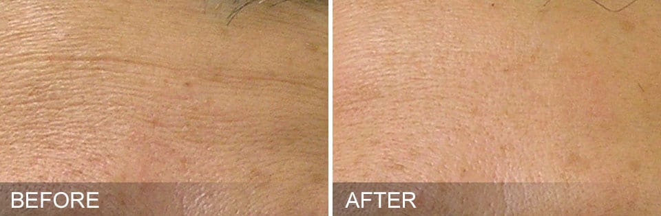 A before and after photo of a woman 's skin spots at Results Skincare Studio in Fort Myers