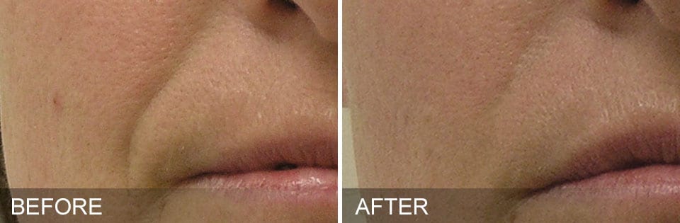 A before and after photo of a woman 's face at Results Skincare Studio in Fort Myers