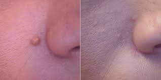 A before and after picture of a person 's nose at Results Skincare Studio in Fort