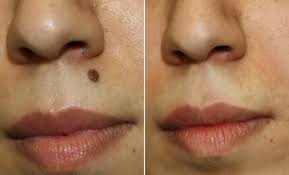 A before and after picture of a woman 's face with a mole on her nose at Results Skincare Studio in Fort