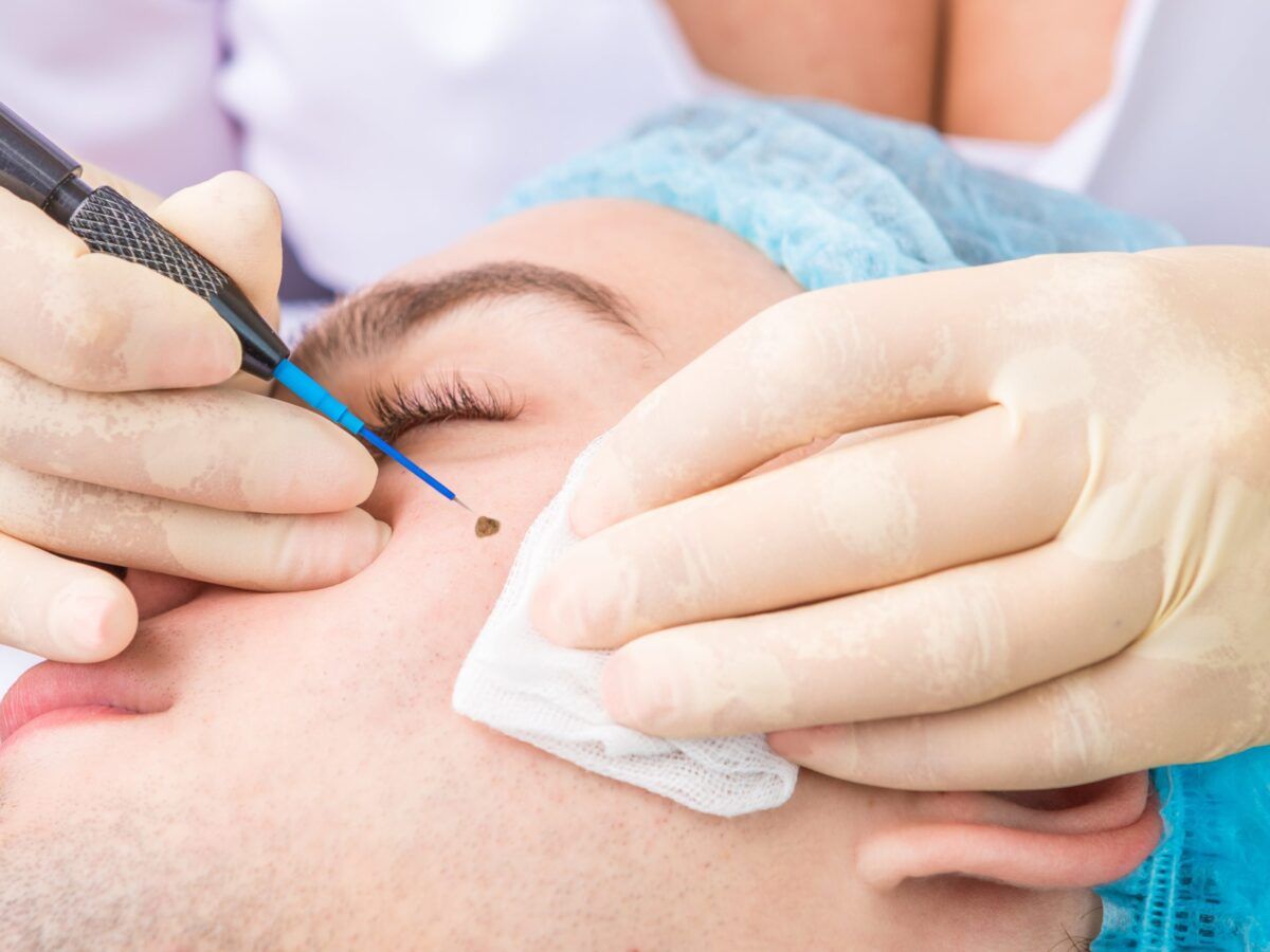 A person is getting a lamprobe treatment at Results Skincare Studio in Fort Myers