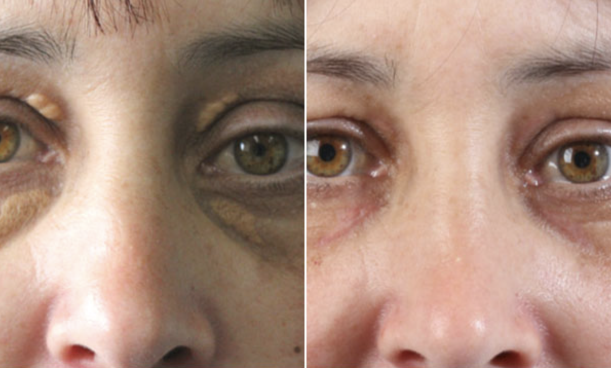 A before and after photo of a woman 's eyes at Results Skincare Studio in Fort
