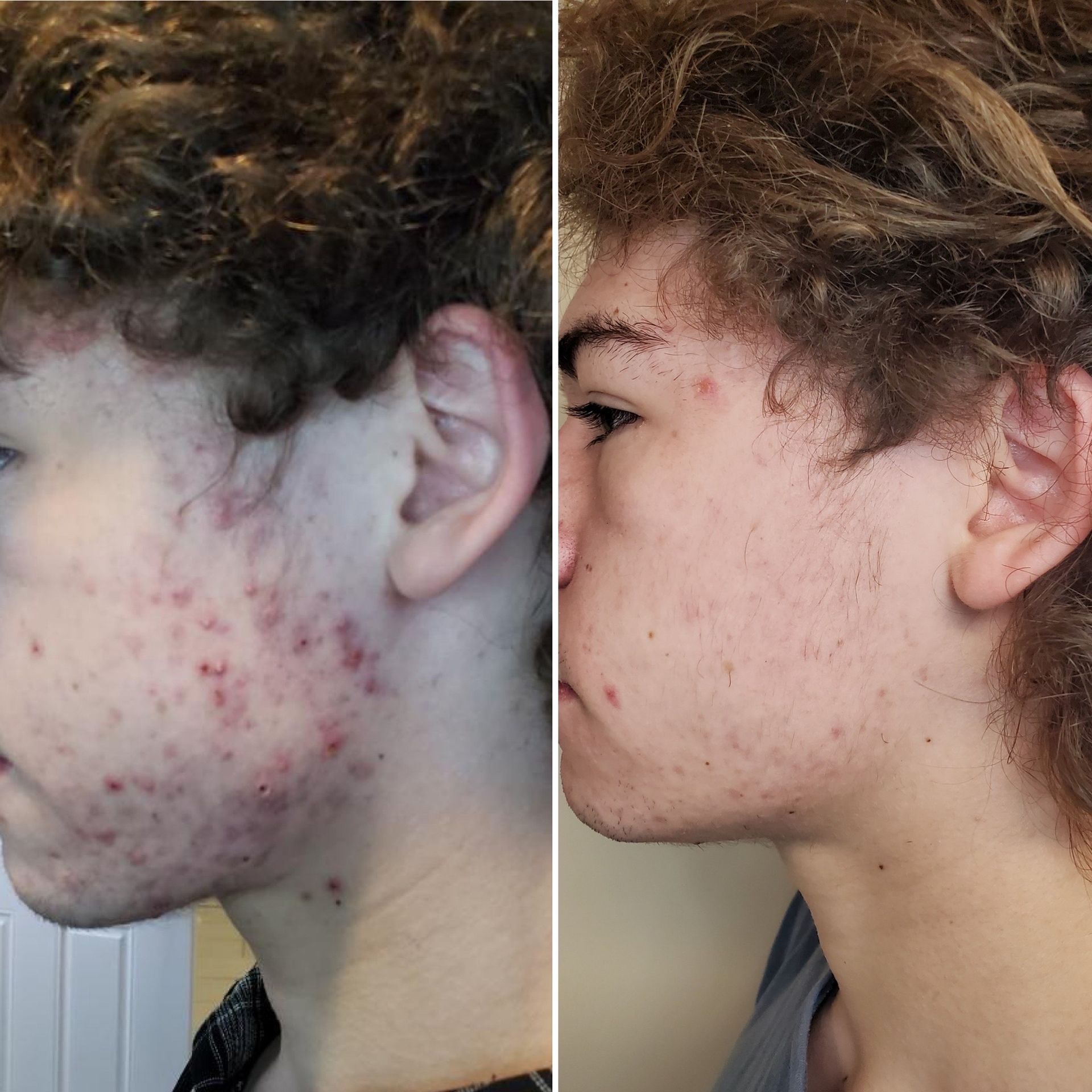 A young man with curly hair has acne on his face at Results Skincare Studio in Fort Myers