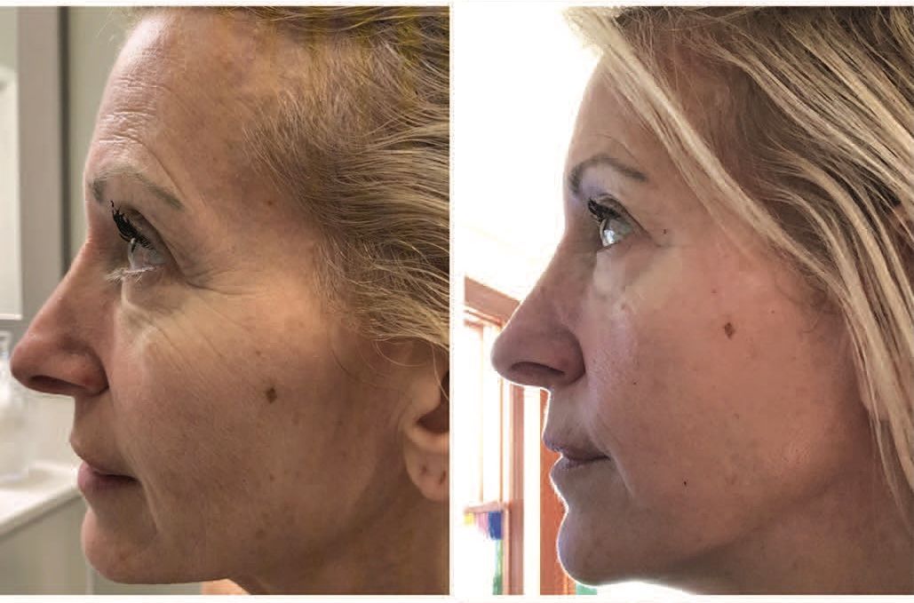 Side-by-side profile photos of the same woman, showing a before-and-after facial comparison