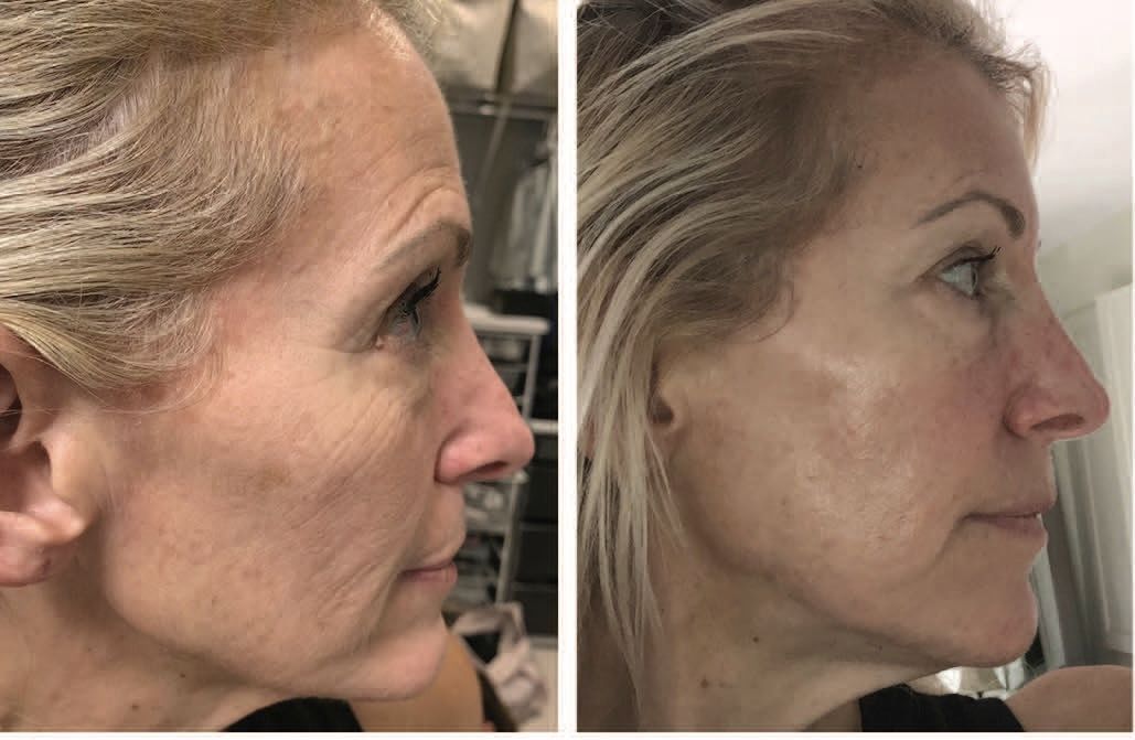 Side-by-side profile photos of a woman’s face, showing before-and-after skin changes.