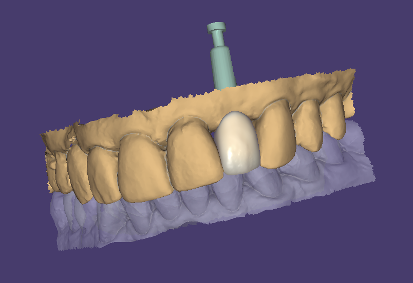 Dental Implants at Durrheim & Associates Blenhein, Marlborough, NZ