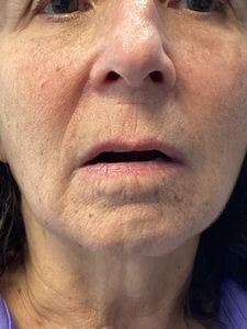 Close-up of a person’s face with a slightly open mouth, neutral expression, and visible lower face wrinkles
