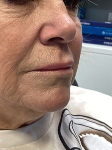 Close-up of a person’s lower face and chin, wearing a white sweater.