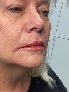 Close-up of a person’s face with swollen, reddened lips and cheek in a tiled room