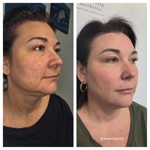 Side-by-side profile portraits of a woman before and after, showing a lighter complexion and smoother skin.