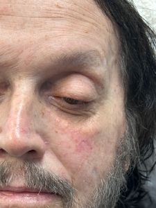 Close-up of a man's face with one eye closed and a neutral expression.