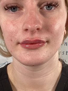 Close-up of a teary face with watery eyes and glossy lips, showing flushed skin and a neutral expression.