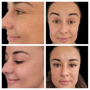 Before-and-after collage of a face, showing side and front views with smoother skin and less redness.