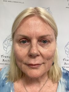 Close-up portrait of a blonde woman with a neutral expression against a clinic-style backdrop.