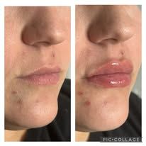 Side-by-side close-up of lips before and after swelling, with one lip glossy and enlarged.
