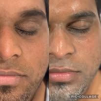 Split close-up of a man’s face showing before-and-after under-eye skincare results.