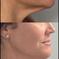 Before-and-after side profile of a chin and jawline, showing a smoother, more defined profile.