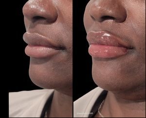 Side-by-side close-up of lips: left dry and uneven, right glossy and more hydrated.