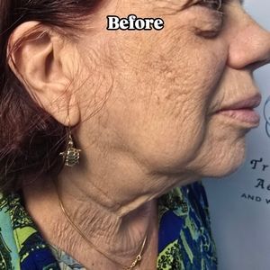 Before: close-up side profile of a woman’s face with visible wrinkles and loose neck skin