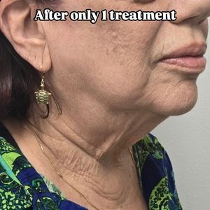 Side profile of a woman showing neck wrinkles, with text overlay reading “After only 1 treatment.”