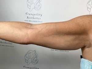 Side view of a person's outstretched leg against a Tranquility Esthetics clinic backdrop